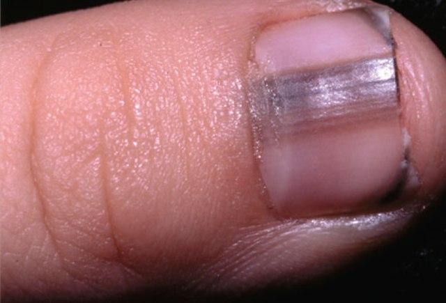 What Causes Fingernail Problems What Causes This 