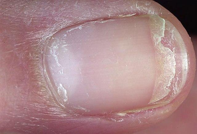 What Causes Fingernail Problems What Causes This 