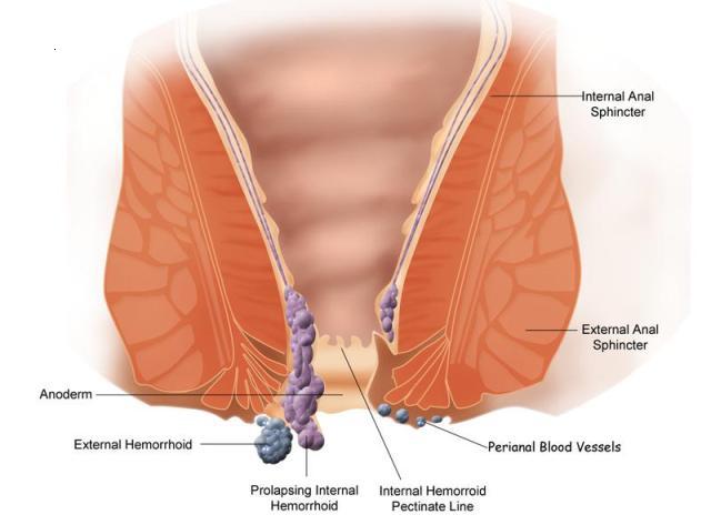 haemorrhoids1