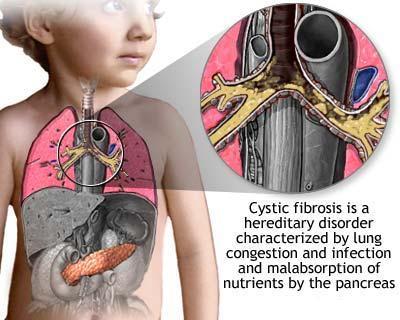 Cystic Fibrosis